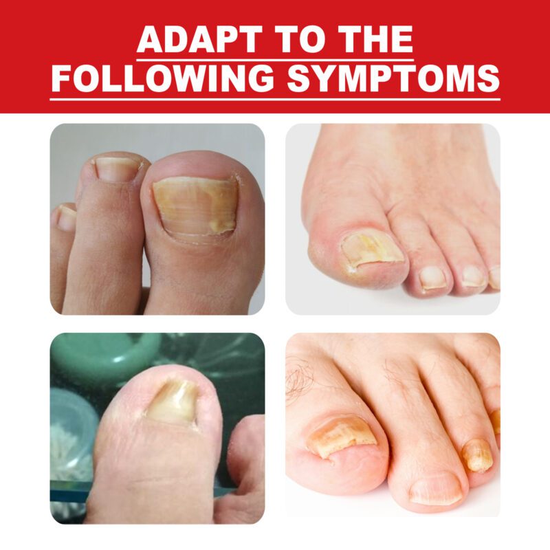 Foot Nail Care Essential Oil (10ml) - Natural Ingredients for Brightening & Softening - Image 3
